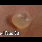what-causes-blisters?