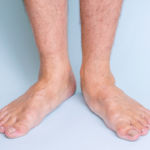 Man's flat feet
