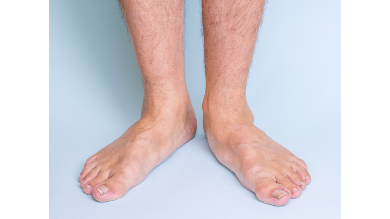 Man's flat feet