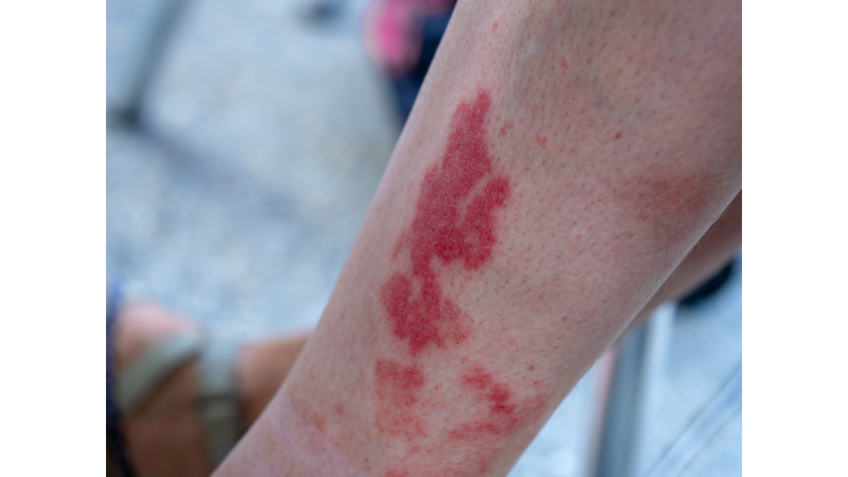Run Rash Hiker's Rash, What Is It? Exploring the Causes, Symptoms, and Treatment ...