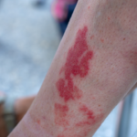 Hikers Rash Vasculitis Rash on leg